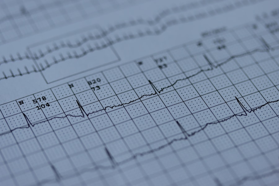 EKG-Ausdruck mit Herzrhythmus (Stock-Foto)